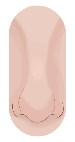 Profile drawing of a bumpy nose: a ridge partway down the bridge